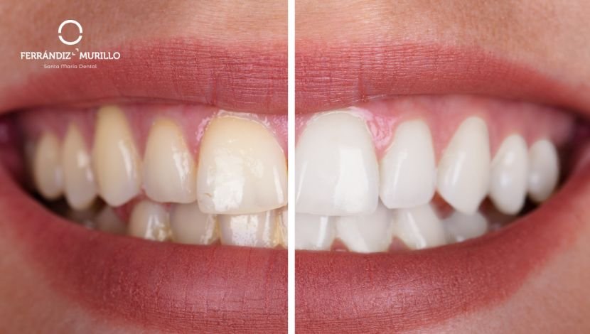 Sonrisa perfecta con blanqueamiento dental