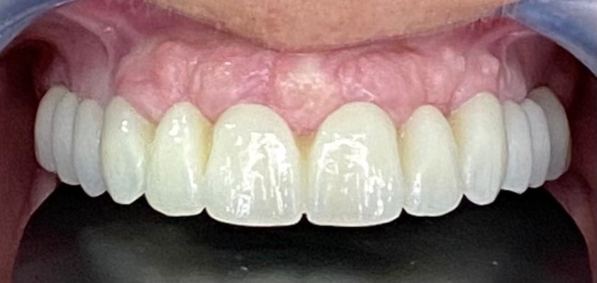 El resultado de un implante bien hecho en Puerto de Santa María