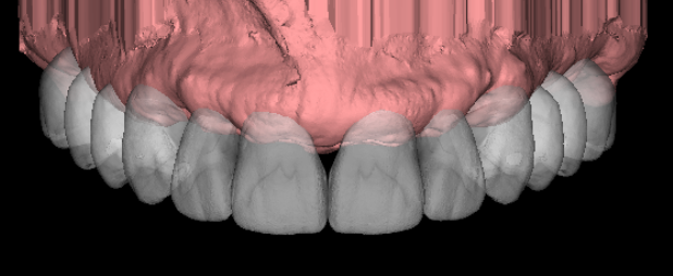 Implante dental en 3d