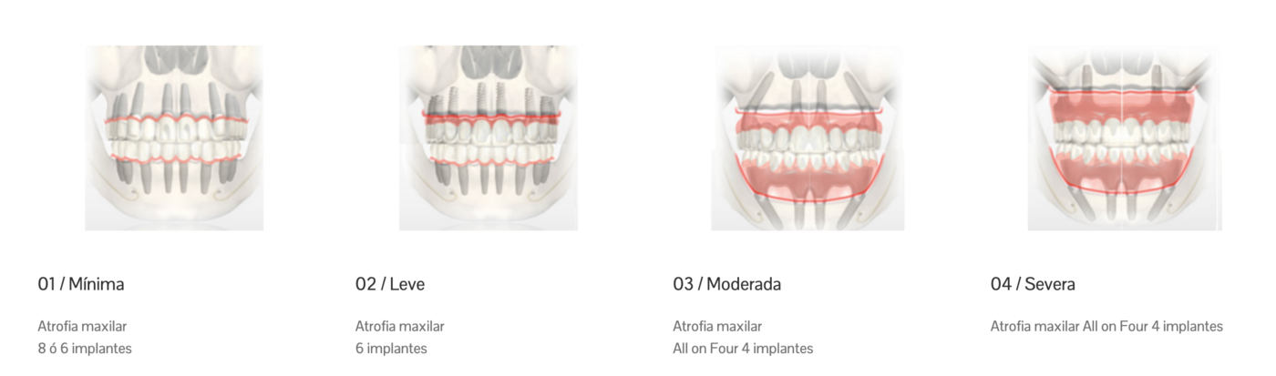 Implantología inmediata en El Puerto de Santa María
