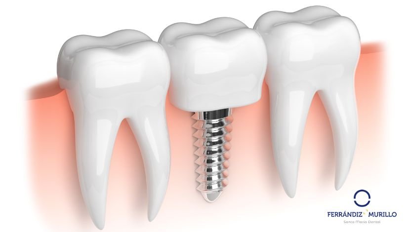 Infección en implante dental - por qué ocurre