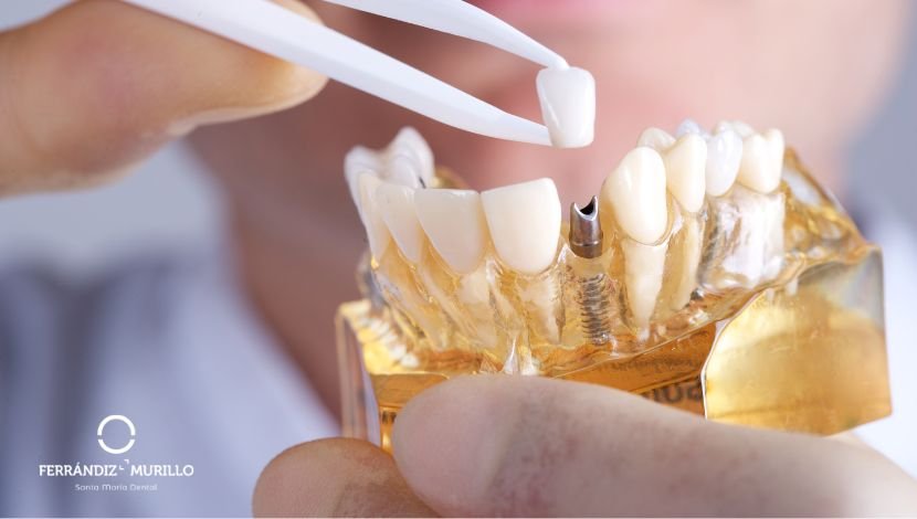 Por qué es importante tener hueso para los implantes dentales