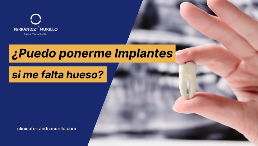 ¿Puedo ponerme Implantes dentales si me falta hueso?