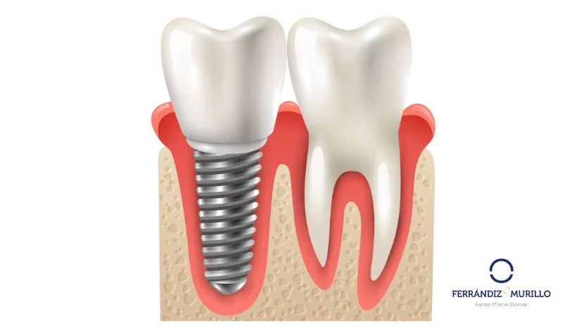 Implantes dentales de titanio y de zirconio