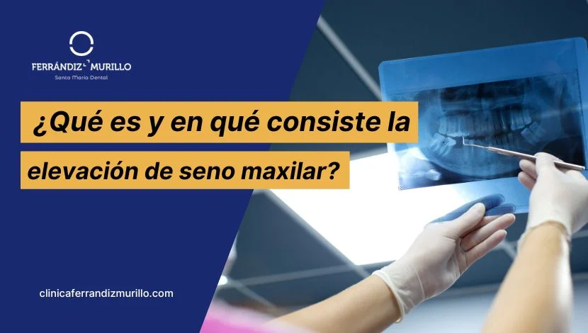 Qué es y en qué consiste la elevación de seno maxilar