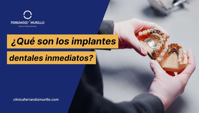 Qué son los implantes dentales inmediatos