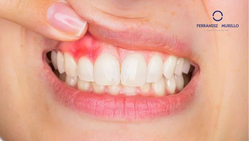 Gingivitis y Periodontitis