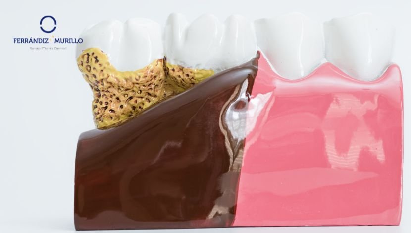 Por qué es importante tener un correcto cuidado periodontal