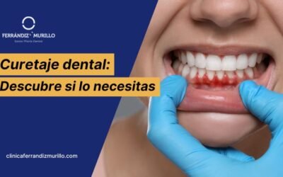 ¿Qué es un Curetaje dental, cómo se realiza y cuándo lo necesitas?