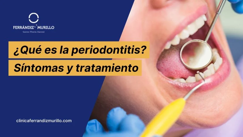 Periodontitis qué es síntomas y tratamiento