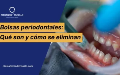 Bolsas periodontales: qué son, por qué se forman y cómo se eliminan