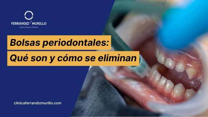 Bolsas periodontales que son