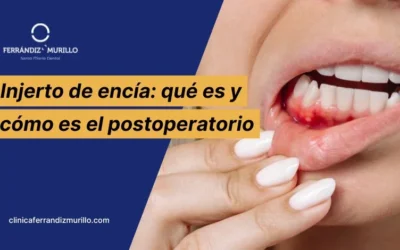 Injerto de encía: en qué consiste, cuándo lo necesitas y cómo es el postoperatorio