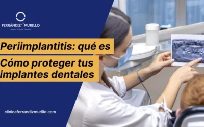Periimplantitis: qué es y cómo proteger tus implantes dentales