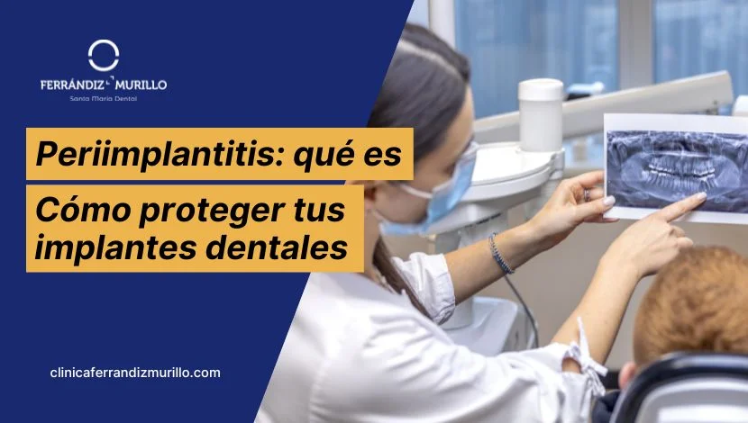 Periimplantitis cómo proteger tus implantes dentales