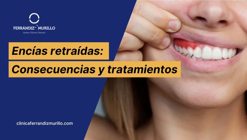 Encías retraídas