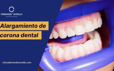Alargamiento de corona dental: cuándo se necesita y en qué consiste