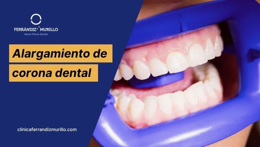 Alargamiento de corona dental