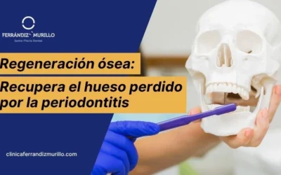 Regeneración ósea periodontal: cómo se recupera el hueso perdido por la periodontitis