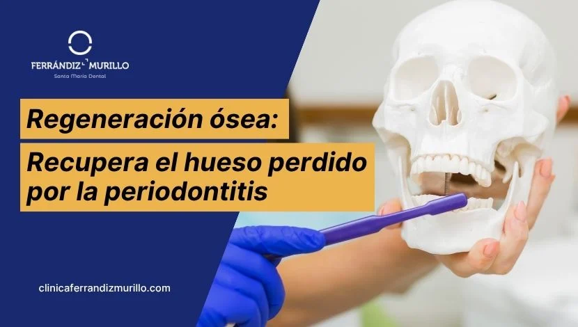 Regeneración ósea periodontal