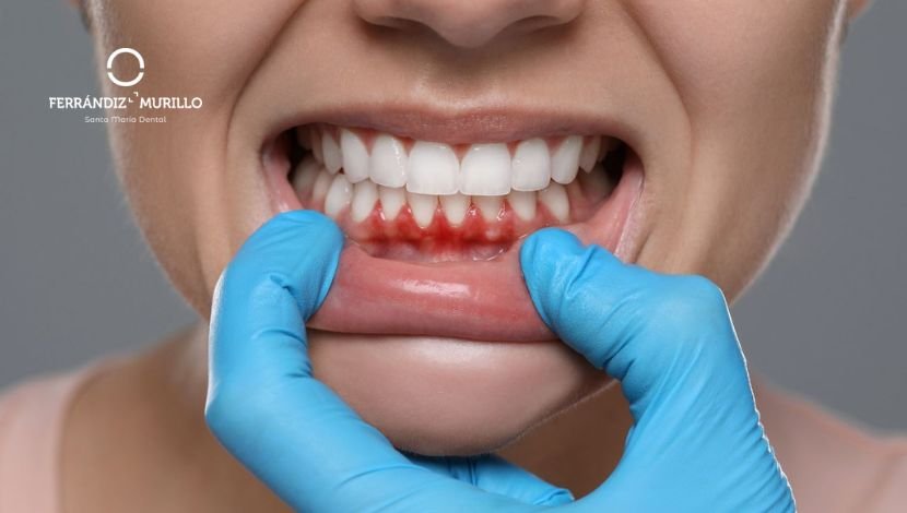 Mal aliento y periodontitis