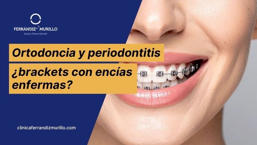 Ortodoncia y periodontitis