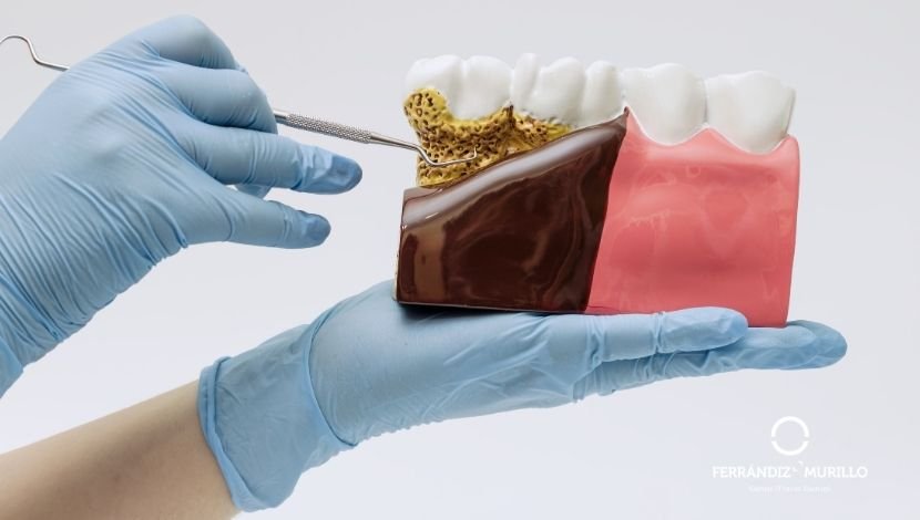 Que es la regeneración tisular guiada en periodoncia Clínica Ferrándiz Murillo